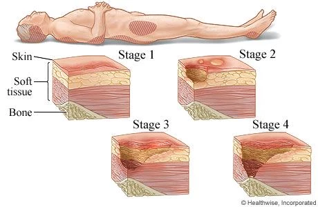 Le medicazioni avanzate delle lesioni da pressione