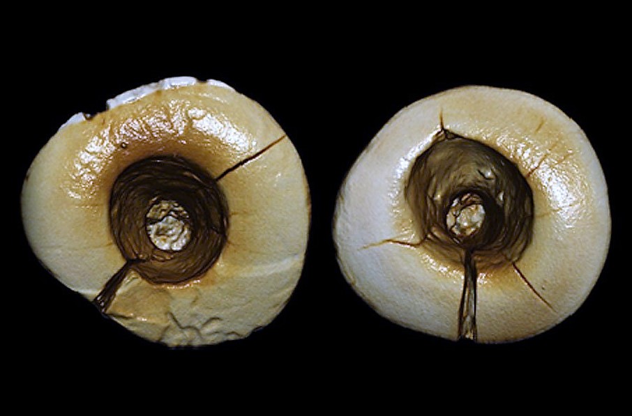 Una grande scoperta. L'otturazione più antica ha 13.000 anni, ed è opera di un garfagnino